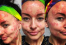 Everything You Need To Know About Plaque Psoriasis Everything You Need To Know About Plaque Psoriasis