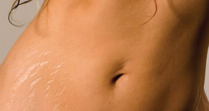 Is It Possible to Get Rid of Stretch Marks?